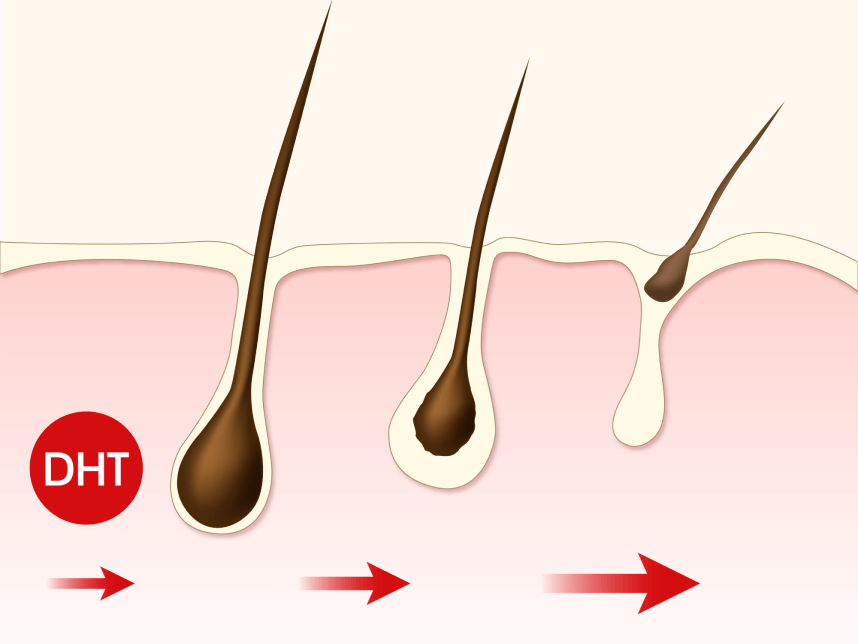 Hair Loss Treatment for Men Hair Loss Products for Men